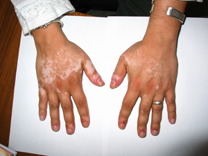 After treatment : July 2004