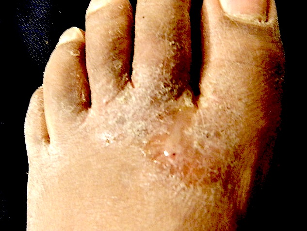 Yellow infection