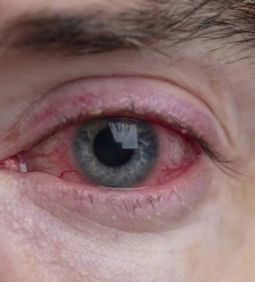 ayurvedic eye treatment
