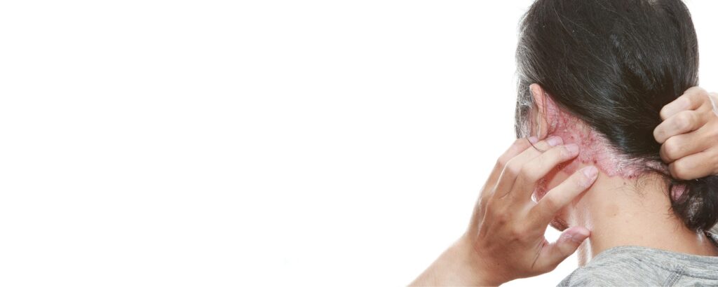 Ayurvedic Treatment for Psoriasis 1 ayurvedic treatment for psoriasis in sydney