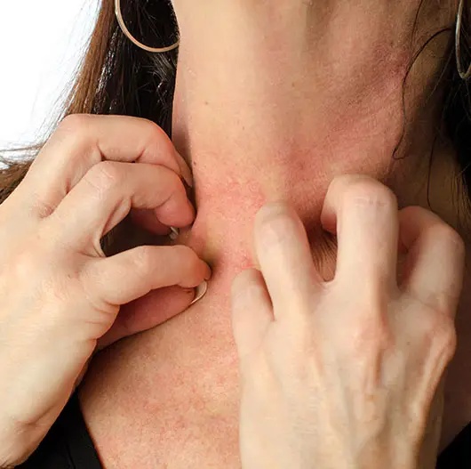 Ayurvedic versus Western medical approach to eczema treatment — root cause vs symptom management