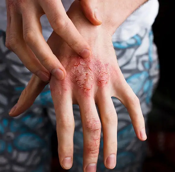 Person with eczema receiving natural Ayurvedic treatment at Yatan Sydney