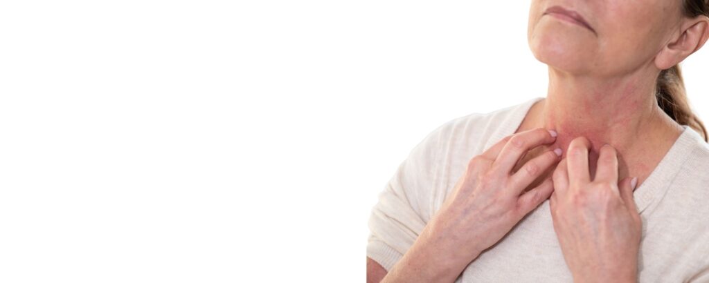 eczema natural healing