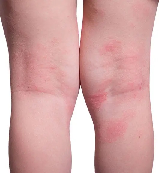 Different types of eczema — atopic dermatitis, contact dermatitis, nummular, dyshidrotic, seborrheic, stasis