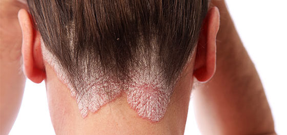 what is psoriasis edited