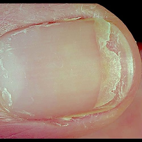 Sexually transmitted diseases Symptoms of STDs Treatment