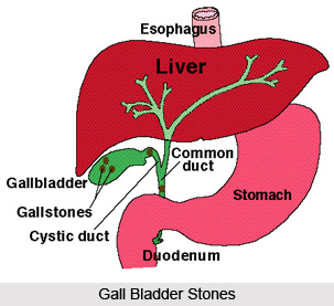 Gall Bladder Stones