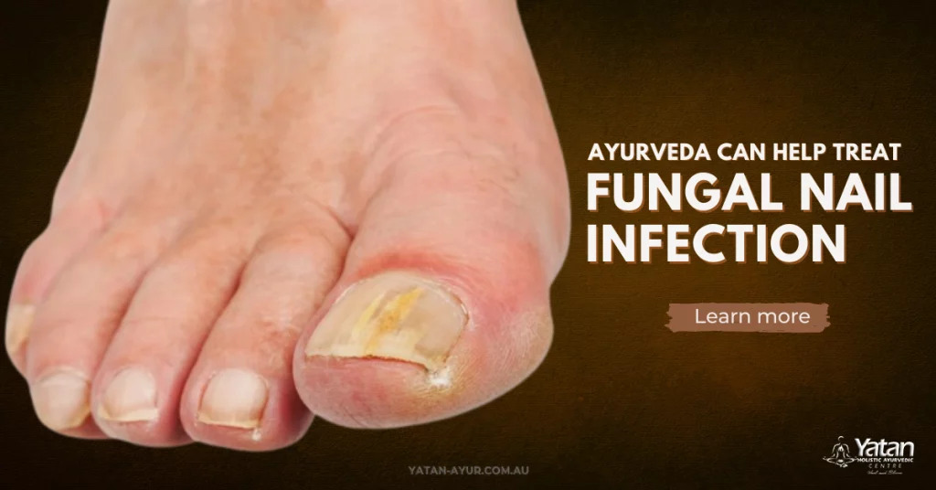 Treat Fungal Nail Infection