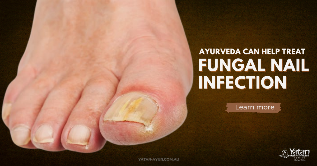 Ayurveda Can Help Treat Fungal Nail Infection Yatan Ayurveda