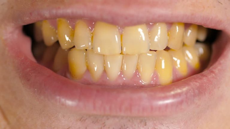 Yellow Teeth - The Real Cause and Treatment