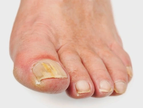 Toenail-Fungus-Infection