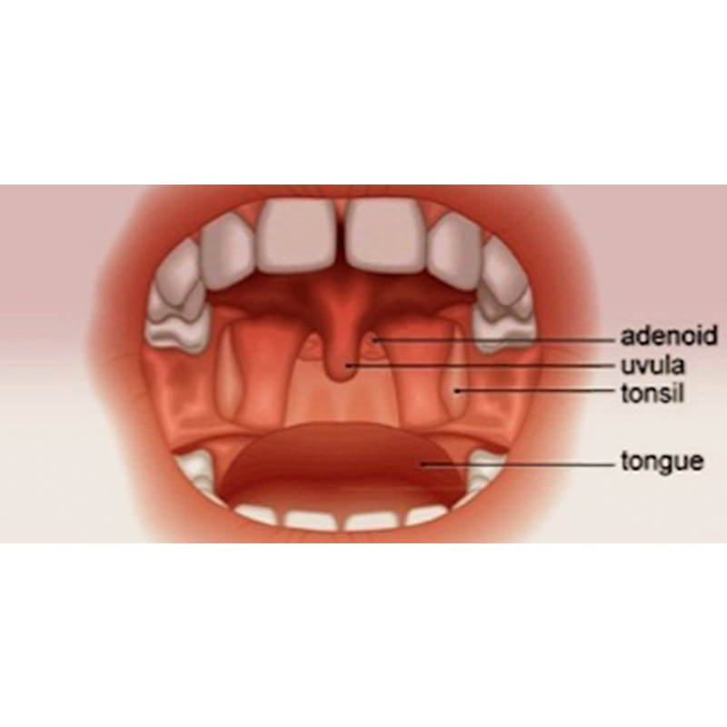 and throat Adult adenoids sore