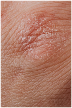 dry skin disorder