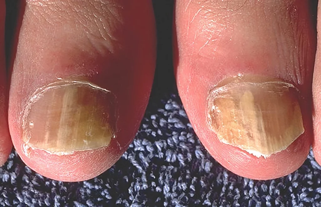 Fingernail infection (paronychia)