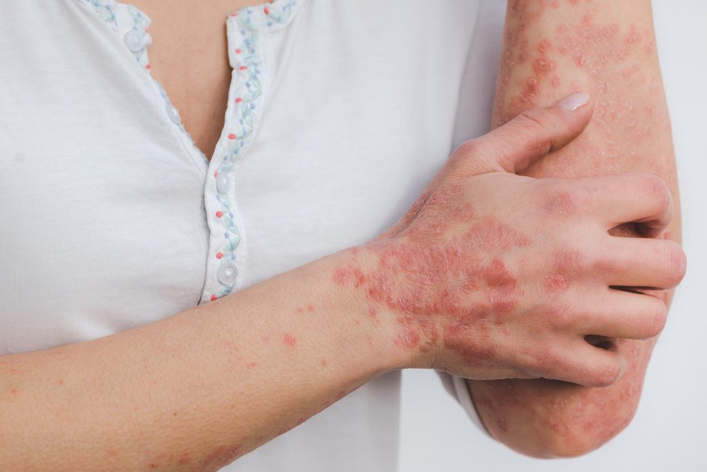 Autoimmune Diseases (psoriasis)