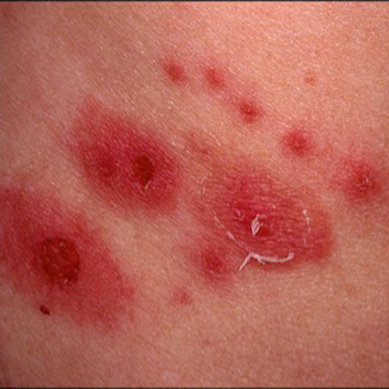 Shingles Symptoms Causes Rash Treatment In Australia Sydney