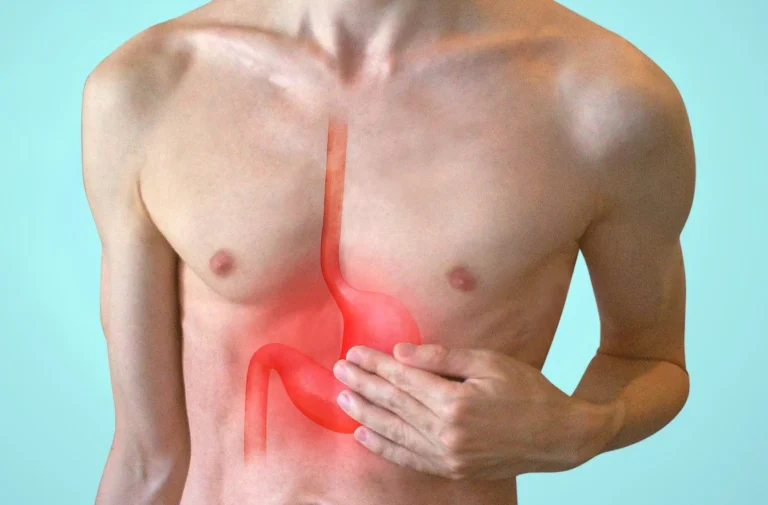 acid reflux