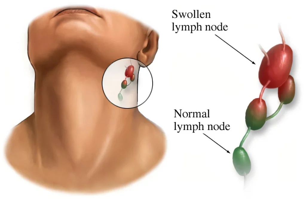 Swollen Lymph Node Neck