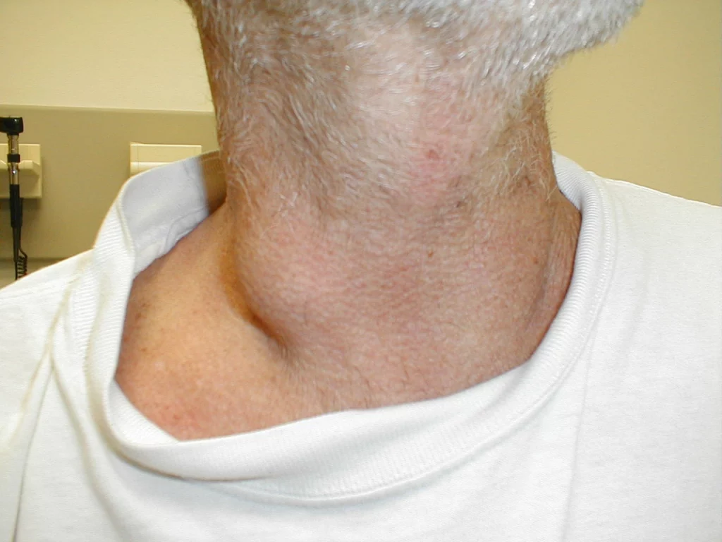 swollen-lymph-nodes-neck
