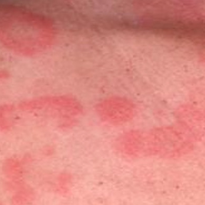 Hives Rash 10 Serious Conditions That Rashes And Hives Can Indicate