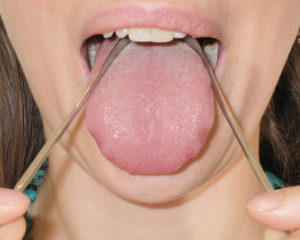 Using the Yatan tongue scraper - start position