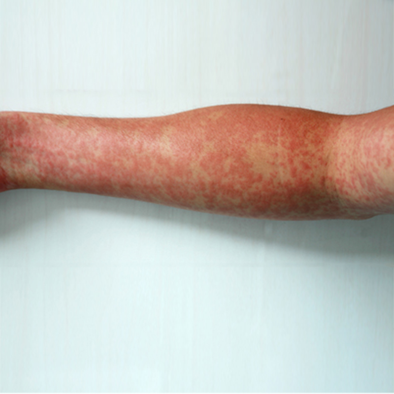 What Is Vasculitis Symptoms And Treatment In Australia