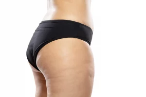 Cellulite - Ironing Out The Creases